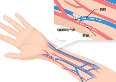 シャント手術